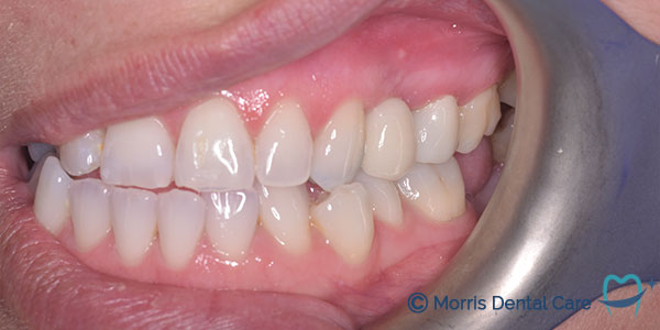 After the treatment which involved composite bonding and teeth whitening our patient's smile gave him more confidence.